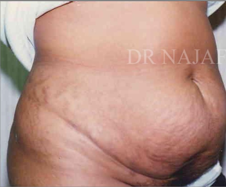 Tummy Tuck before and after - before
