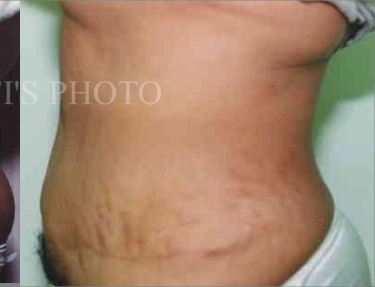 Tummy Tuck before and after - after
