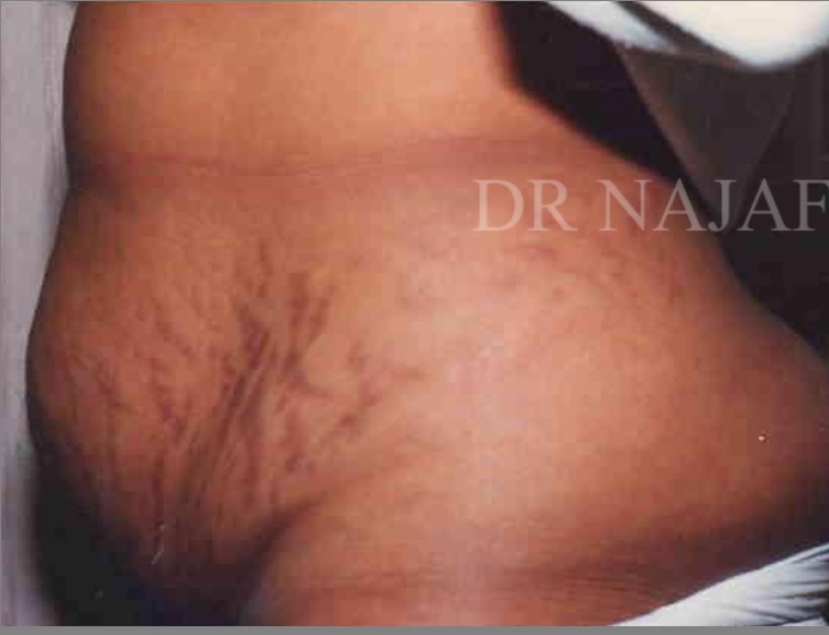 Tummy Tuck before and after - before