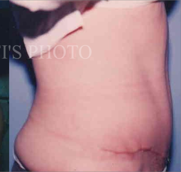 Tummy Tuck before and after - after