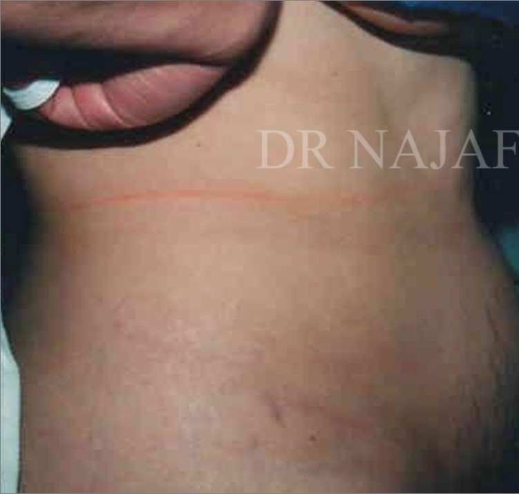 Tummy Tuck before and after - before