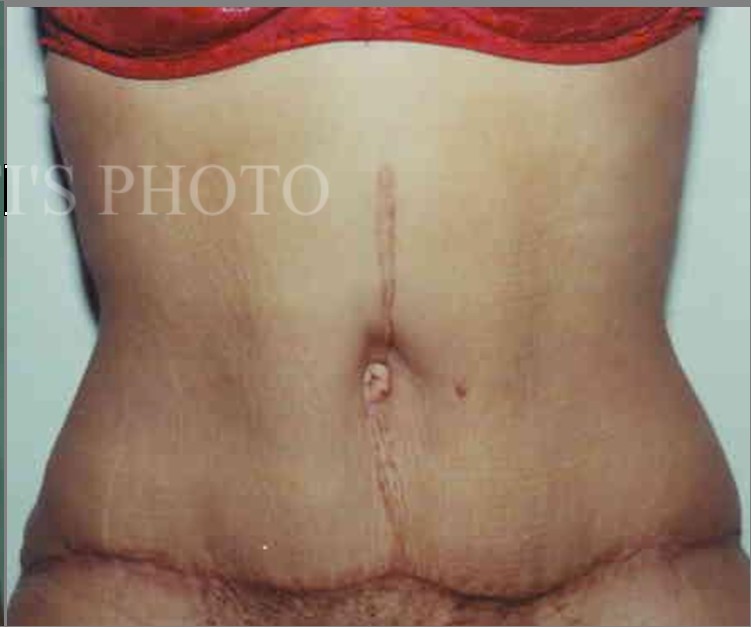 Tummy Tuck before and after - after