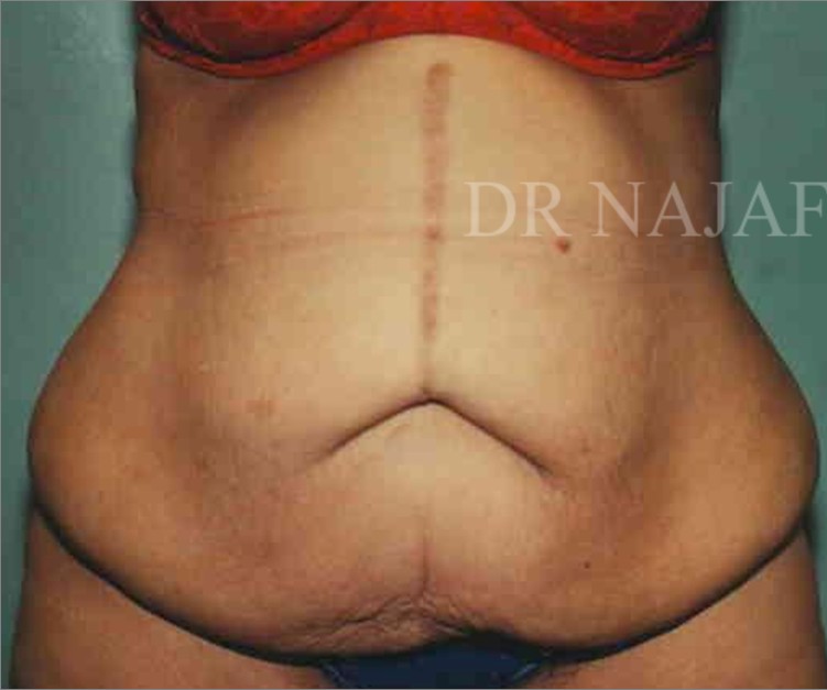 Tummy Tuck before and after - before