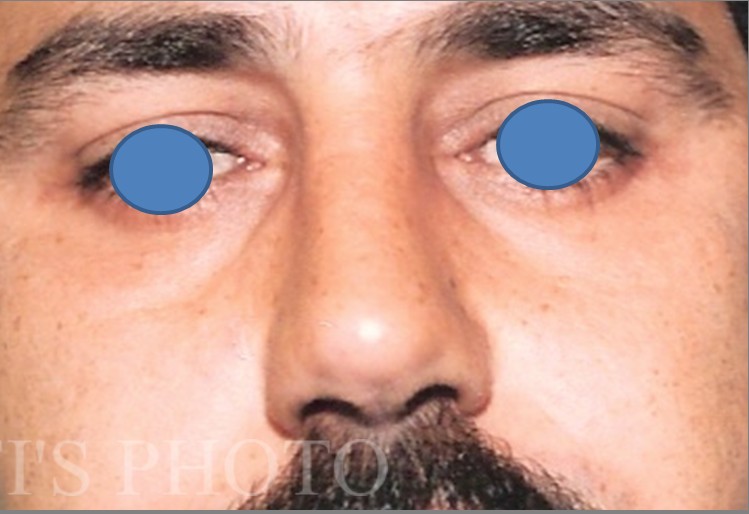 Blepharoplasty before and after - after