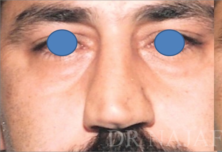 Blepharoplasty before and after - before