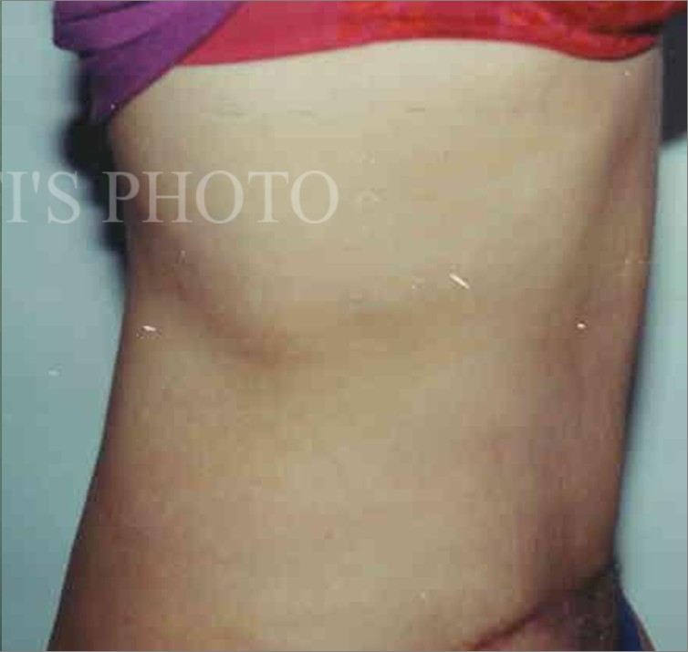 Tummy Tuck before and after - after
