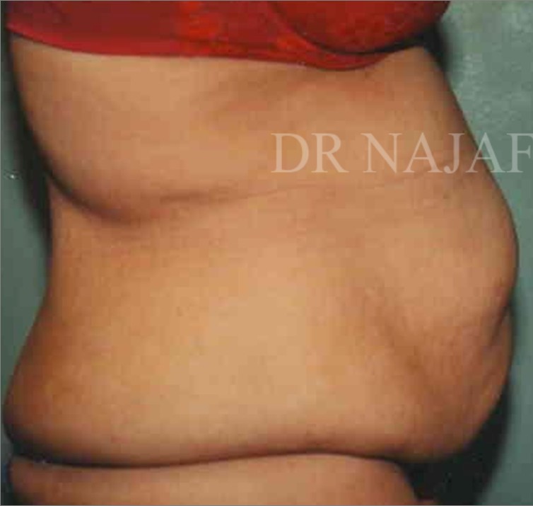 Tummy Tuck before and after - before