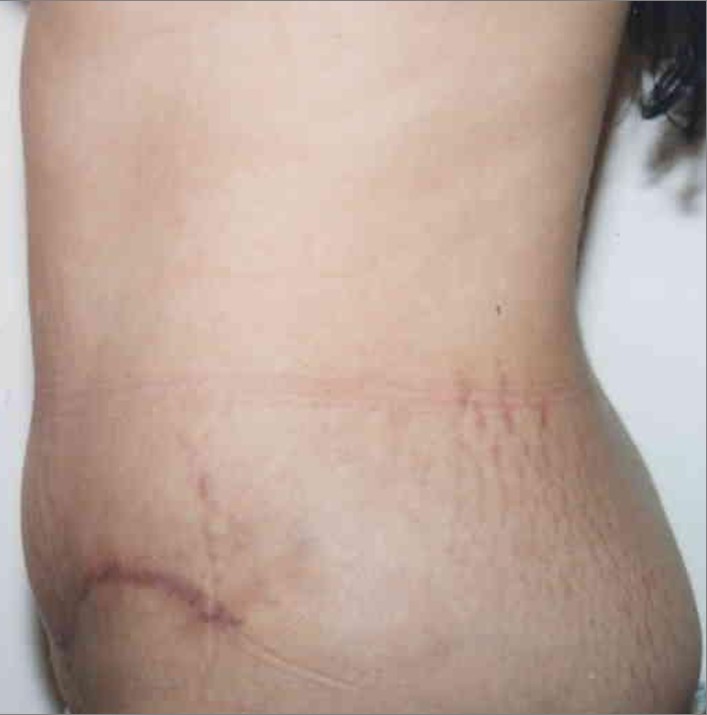 Tummy Tuck before and after - after