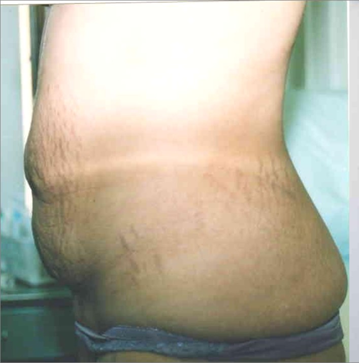 Tummy Tuck before and after - before