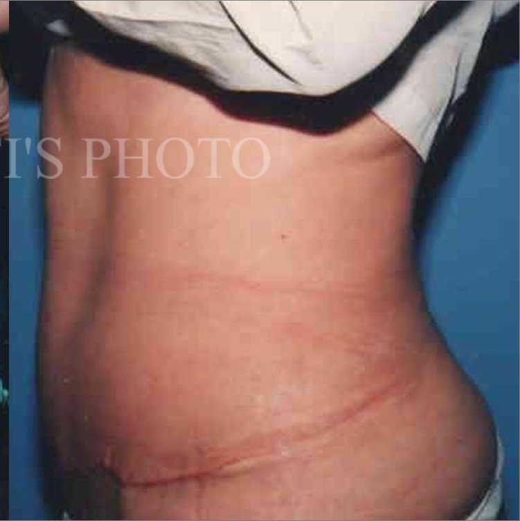 Tummy Tuck before and after - after