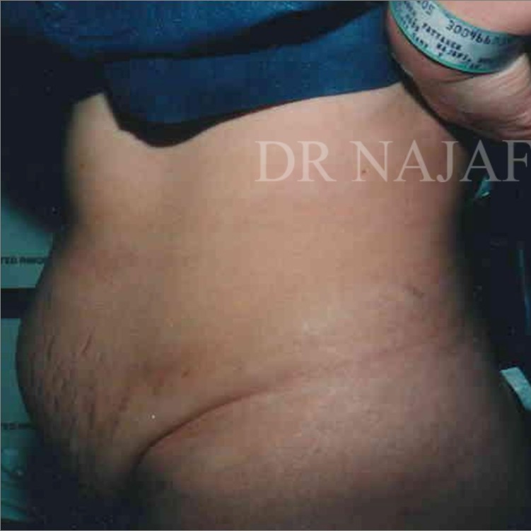 Tummy Tuck before and after - before