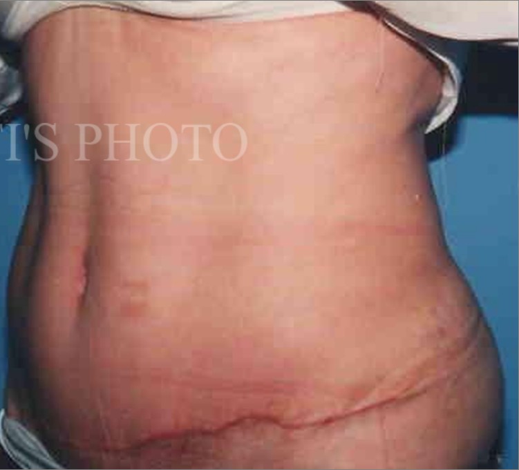 Tummy Tuck before and after - after