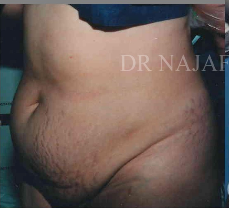 Tummy Tuck before and after - before