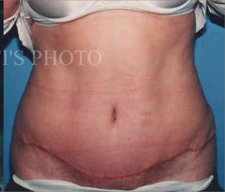 Tummy Tuck before and after - after