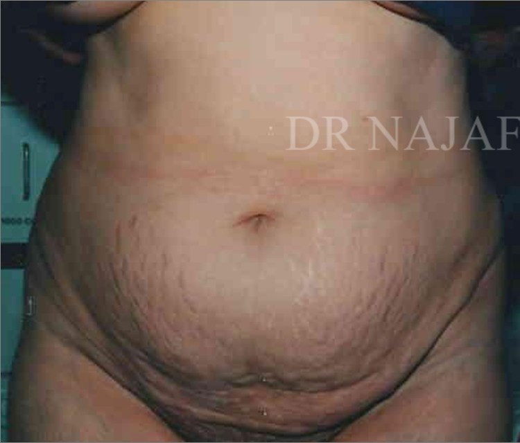 Tummy Tuck before and after - before