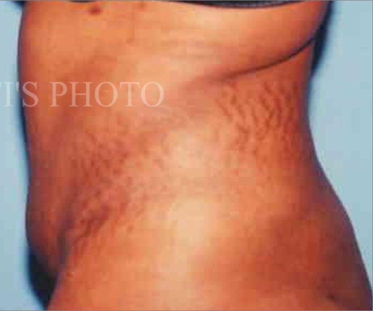 Tummy Tuck before and after - after
