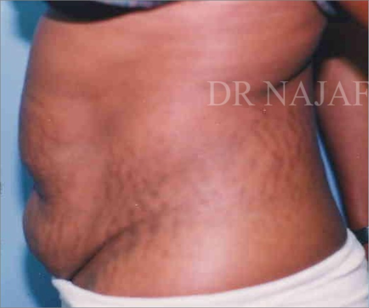 Tummy Tuck before and after - before