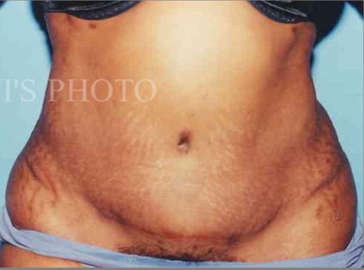 Tummy Tuck before and after - after