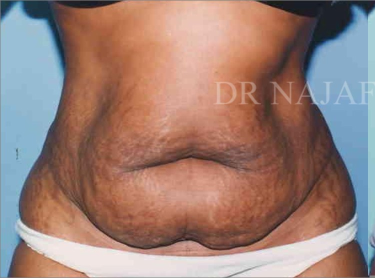 Tummy Tuck before and after - before