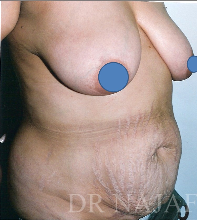 Tummy Tuck before and after - before