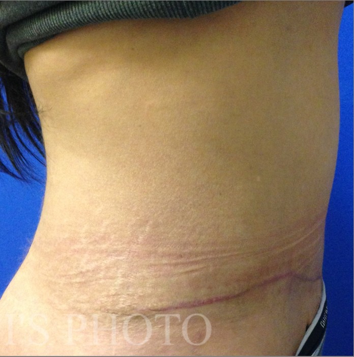 Tummy Tuck before and after - after