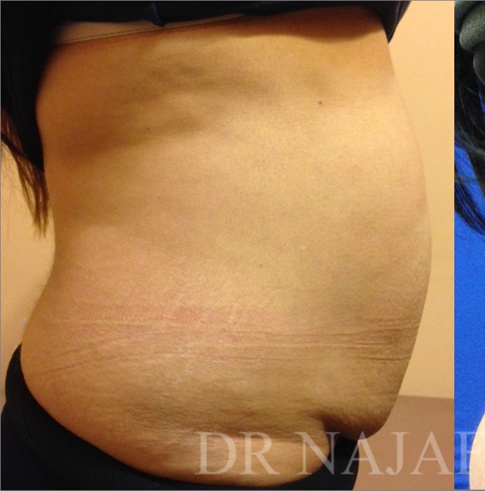 Tummy Tuck before and after - before