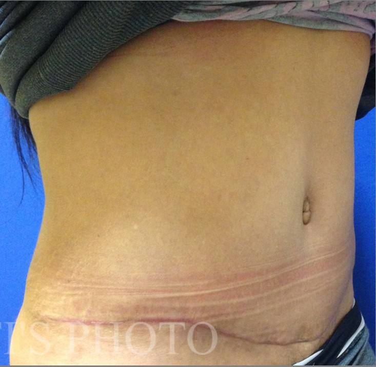 Tummy Tuck before and after - after