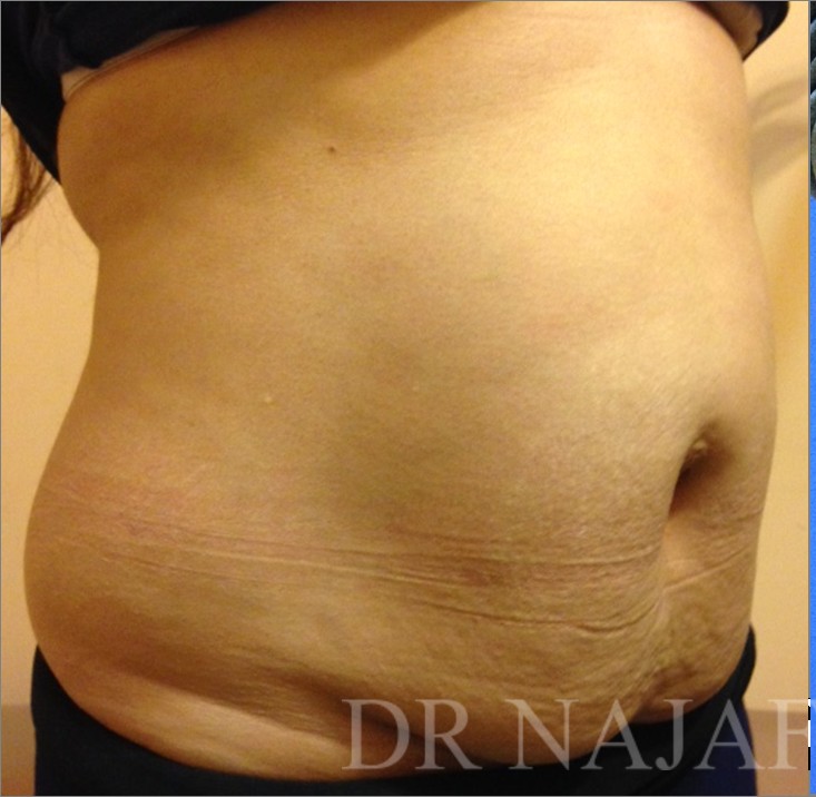 Tummy Tuck before and after - before