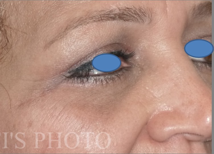 Blepharoplasty before and after - after