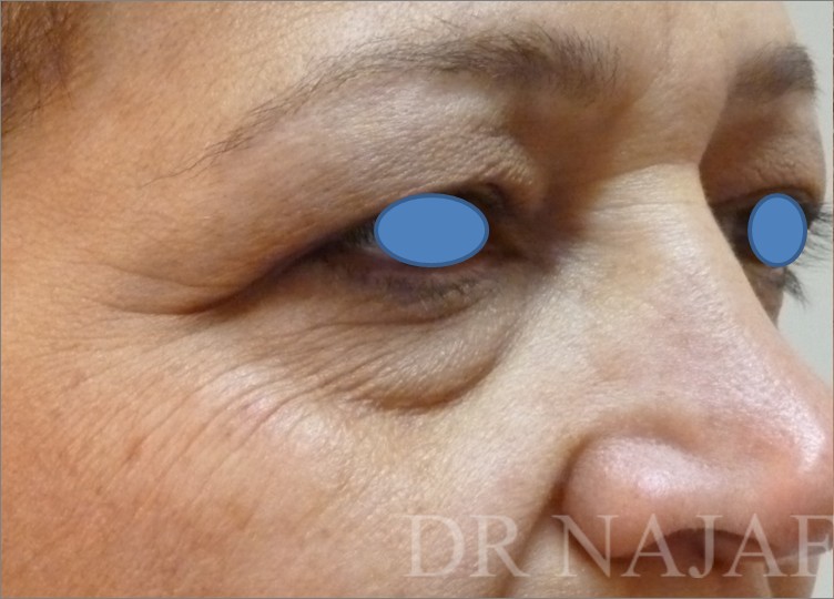 Blepharoplasty before and after - before