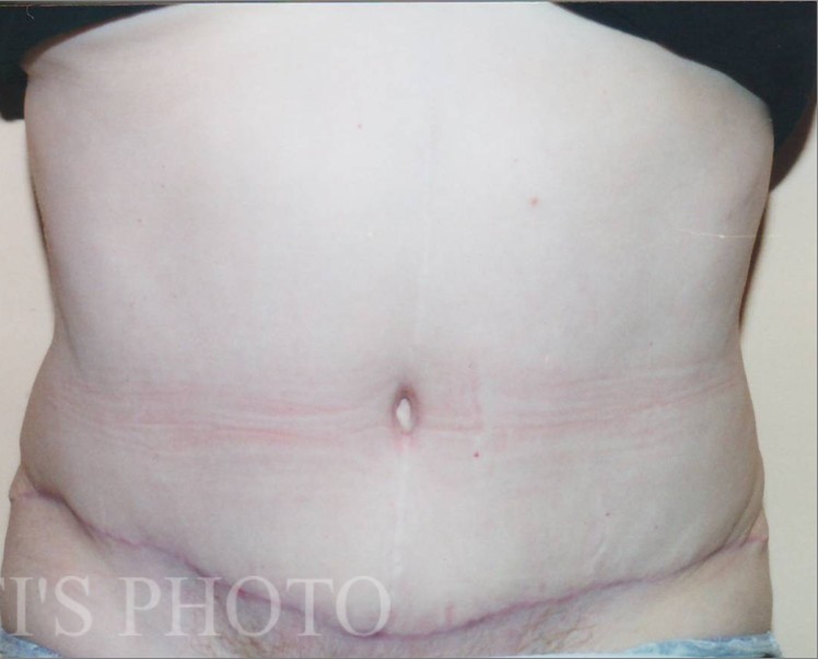 Tummy Tuck before and after - after