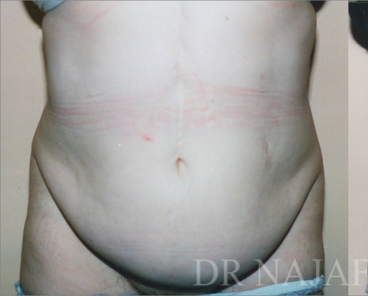 Tummy Tuck before and after - before