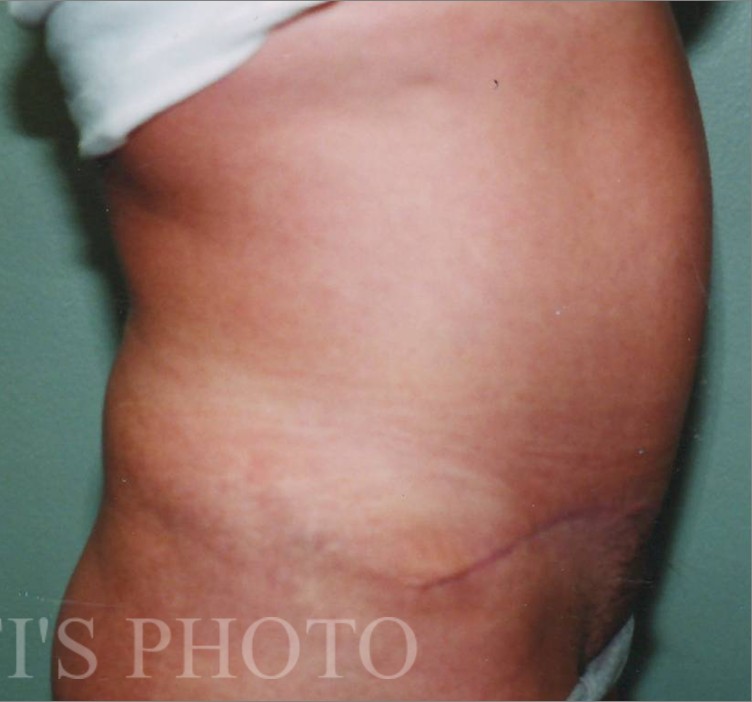 Tummy Tuck before and after - after