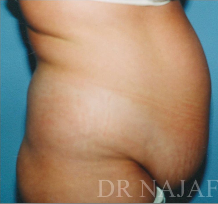 Tummy Tuck before and after - before