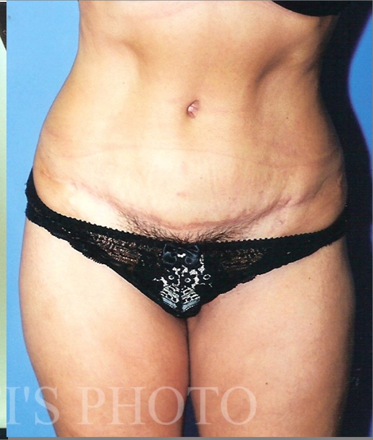 Tummy Tuck before and after - after