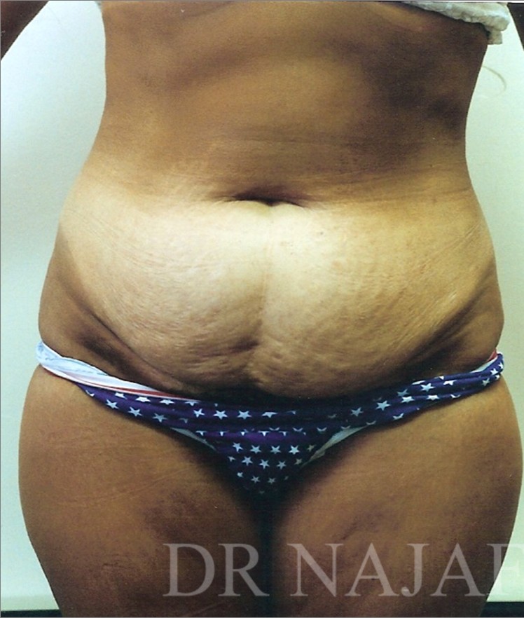 Tummy Tuck before and after - before