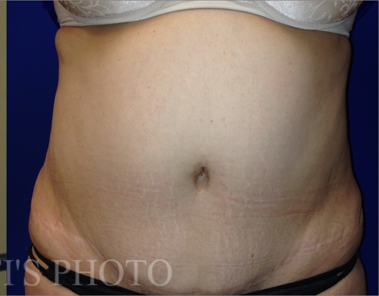 Tummy Tuck before and after - after