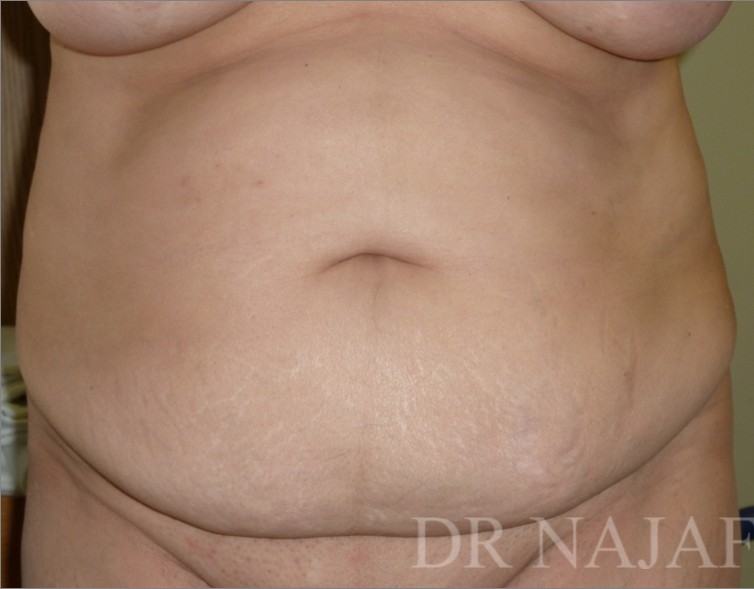 Tummy Tuck before and after - before