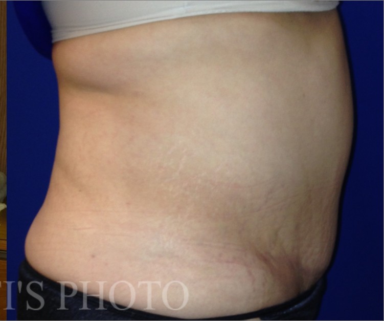 Tummy Tuck before and after - after