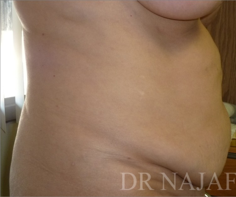 Tummy Tuck before and after - before