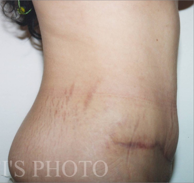 Tummy Tuck before and after - after