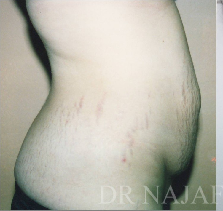 Tummy Tuck before and after - before