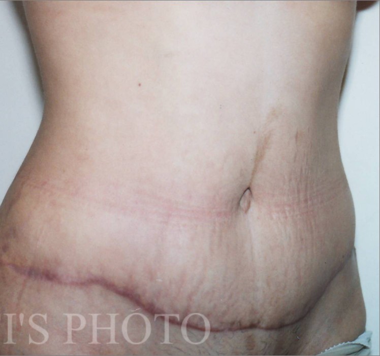 Tummy Tuck before and after - after