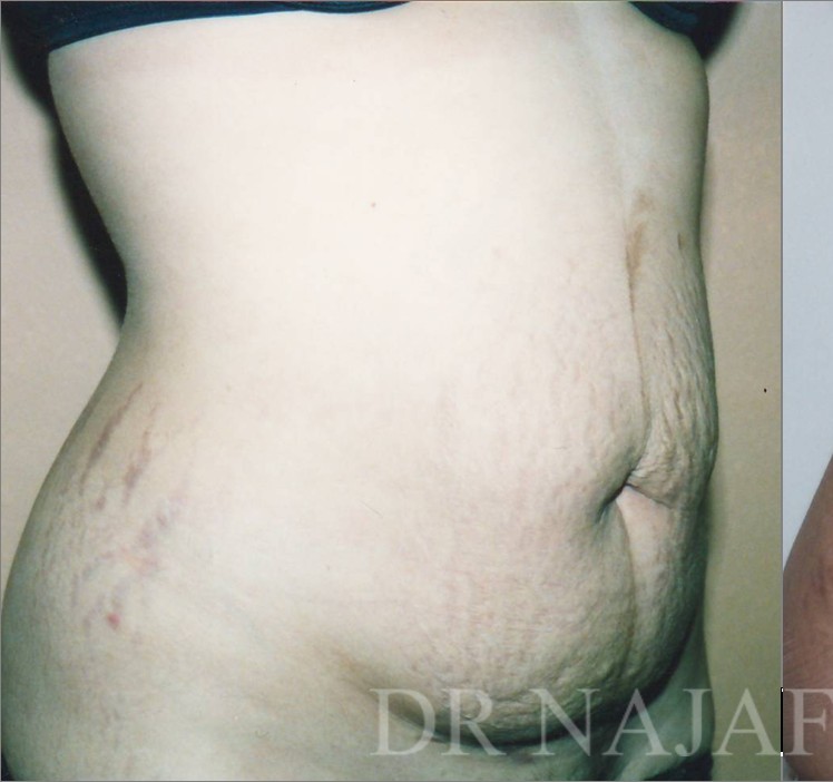 Tummy Tuck before and after - before