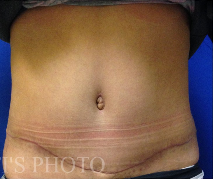 Tummy Tuck before and after - after