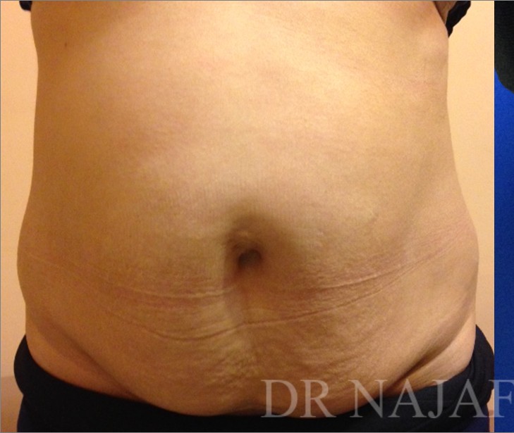 Tummy Tuck before and after - before