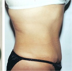 Tummy Tuck before and after - after