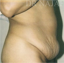 Tummy Tuck before and after - before