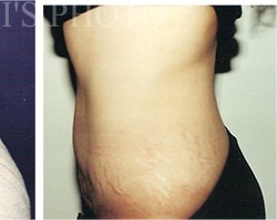 Tummy Tuck before and after - after