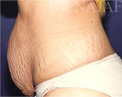 Tummy Tuck before and after - before